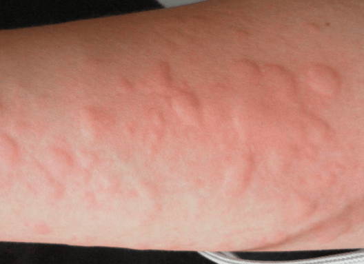 身上突然起了很多红疙瘩,痒得厉害!究竟是怎么回事?