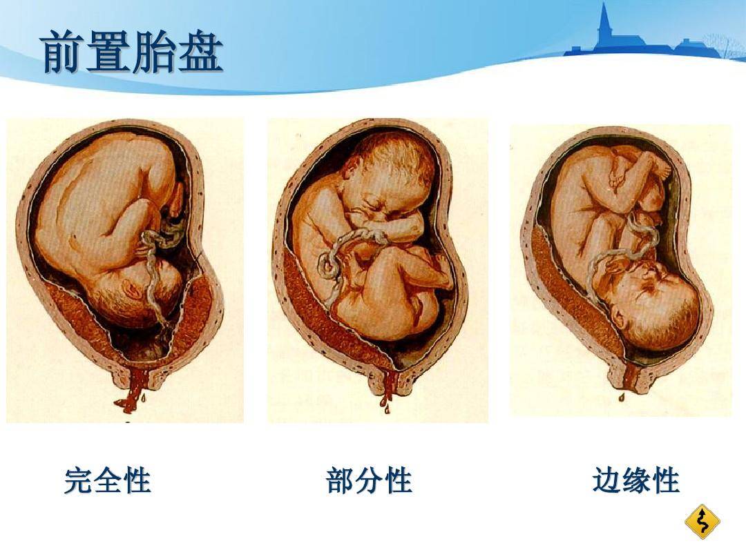 胎盘低置出血图片