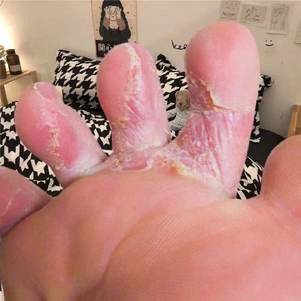 白花那么多钱了,知道这些东西,在家就能彻底根治脚气!_鞋子_效果_消毒