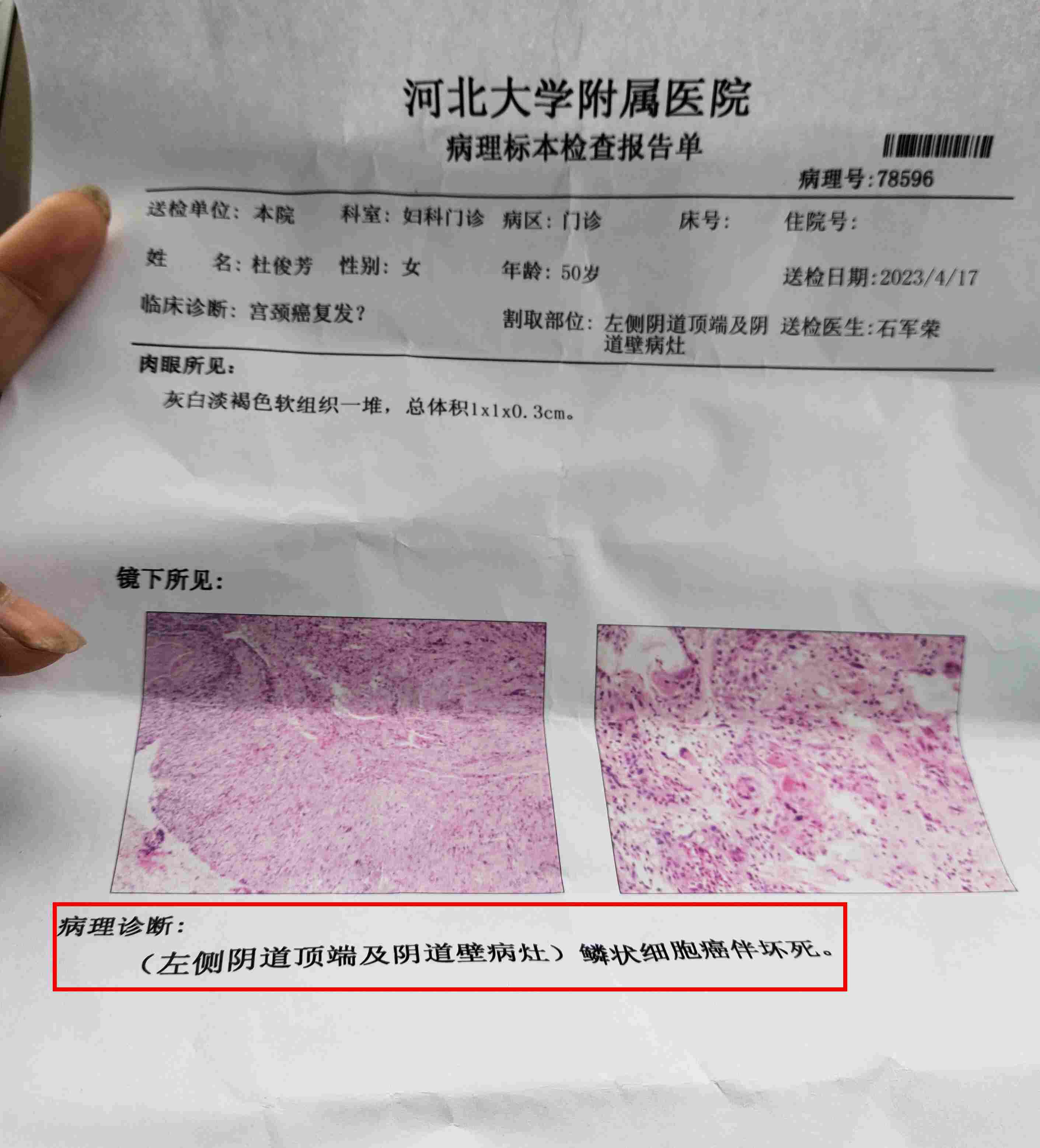 癌症检查报告 确诊图片