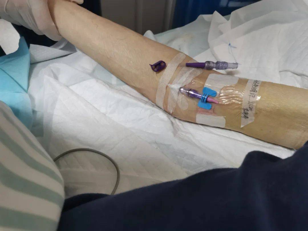 冶金动态丨陕西冶金医院重症医学科成功开展中线迷你导管置管术_患者