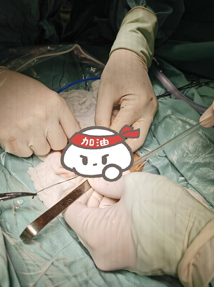 不足3斤早产宝宝肠穿孔危在旦夕!