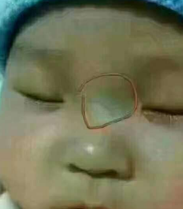 "青筋难养"宝宝鼻梁有"青筋"说明了什么?家长一定要注意!