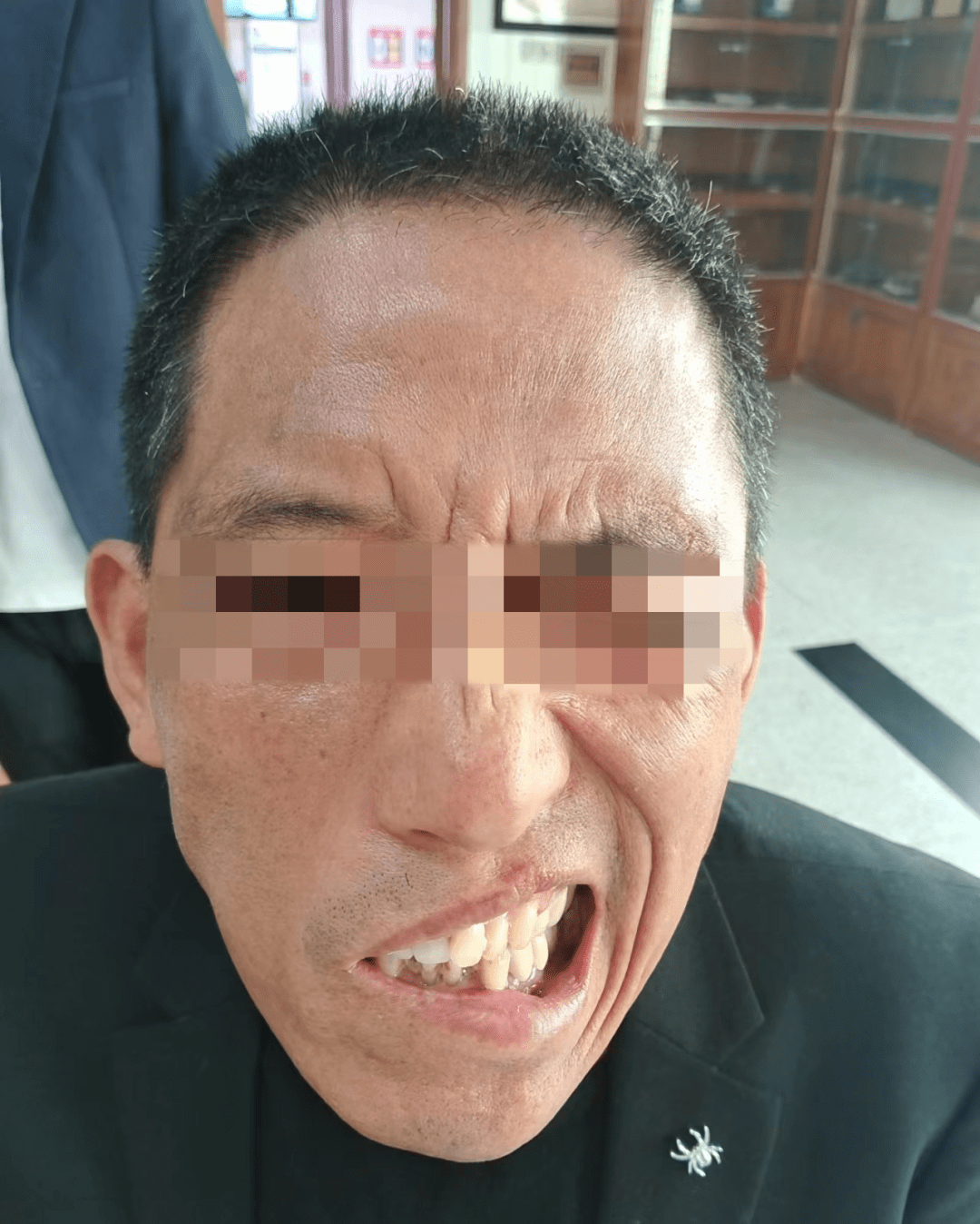 一觉醒来"嘴歪了"?秋季面瘫高发,中医针灸帮你"正脸"_面部_治疗_患者