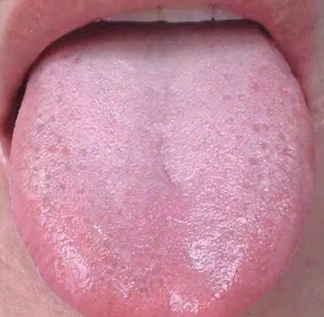 健康色舌头今天,就和大家聊一聊『从舌头看疾病』的那些事!