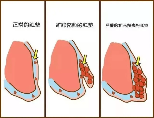 血栓外痔的肉球图片图片