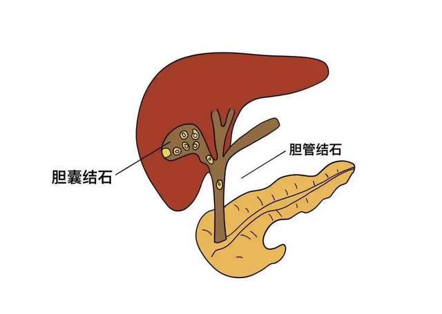 胆结石的4种治疗办法,切除胆囊要注意这5个副作用_胆汁_胆固醇_患者