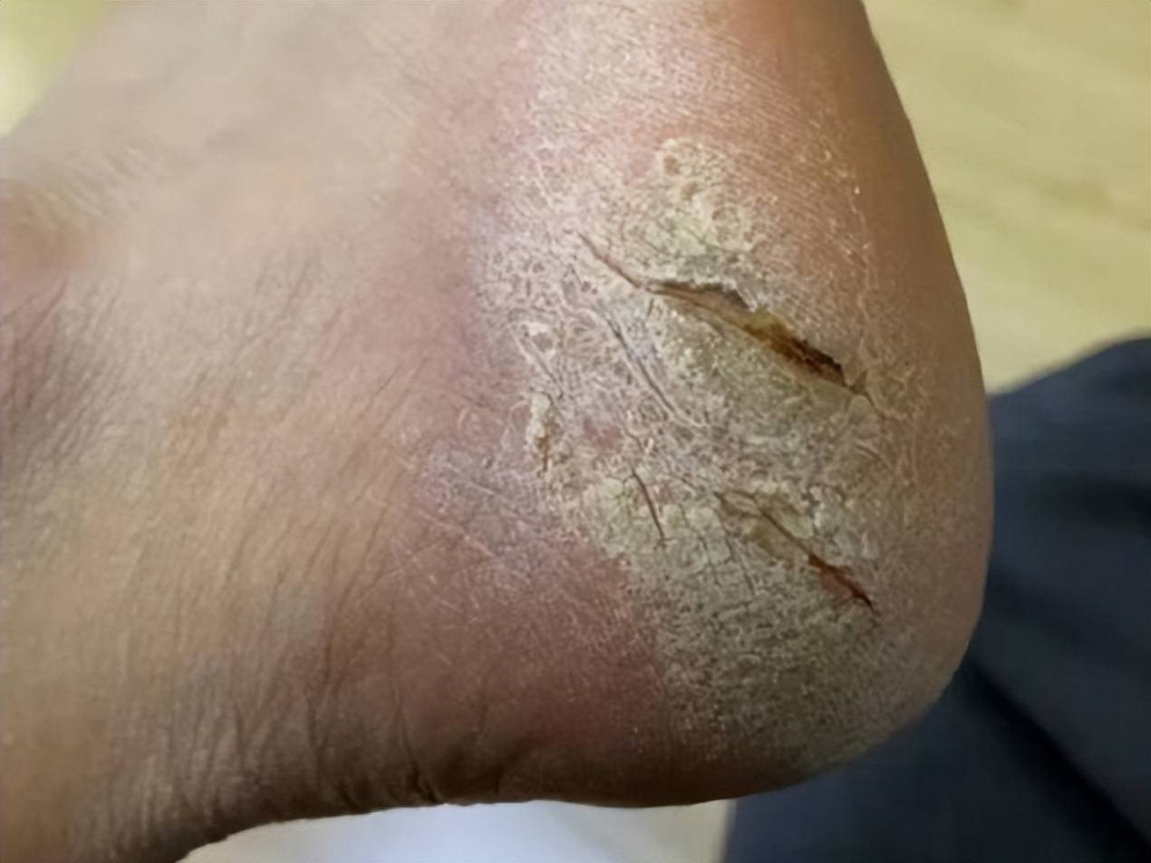 脚后跟干裂脱皮通通消除!成本几毛钱的根治妙招来袭,抓紧码住!