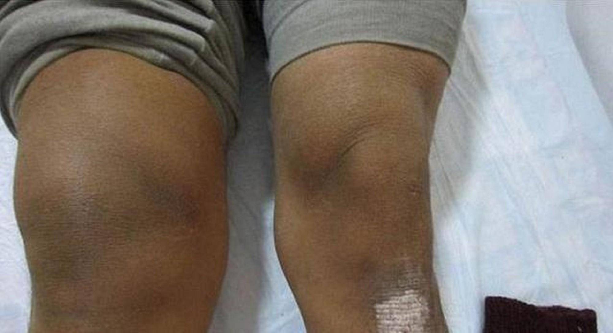 并且身体内尿酸偏高,但风湿因子是阴性,所以说是膝盖的滑膜炎以及痛风