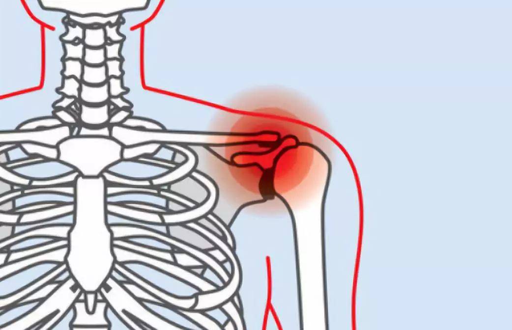 肩周炎的疼痛并非来得突然