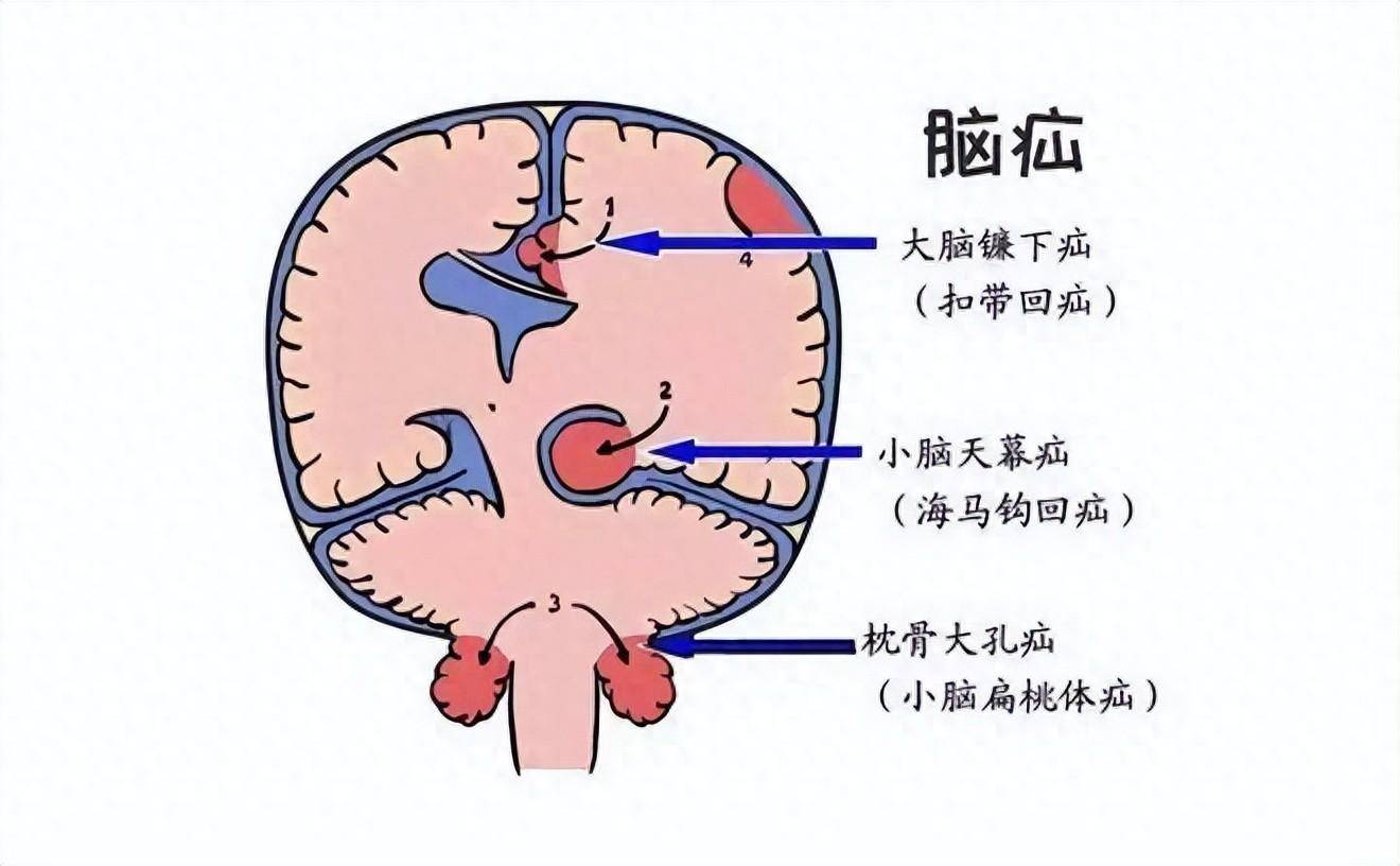 脑组织被迫通过颅骨缺陷或者天然开口(如脑干孔,大脑镰孔等)向颅外