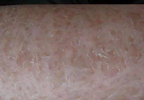 鱼鳞皮肤治疗方法图片