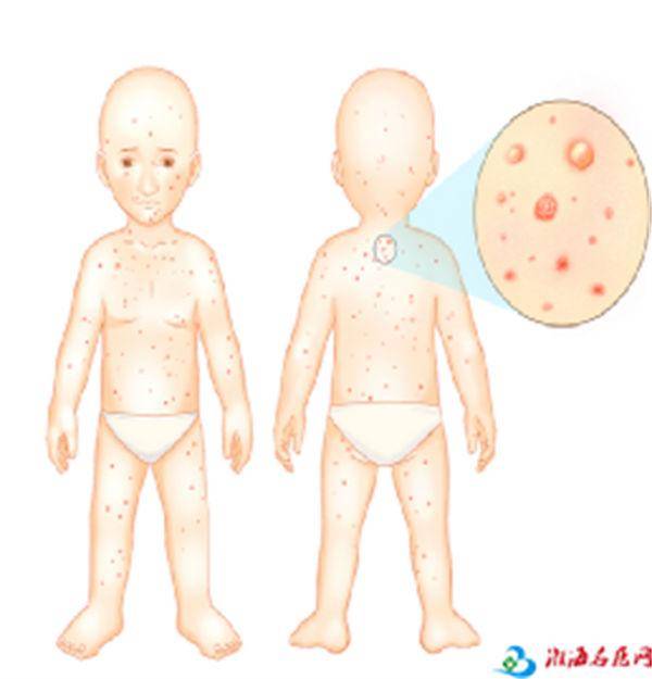 幼儿水痘的症状和治疗图片