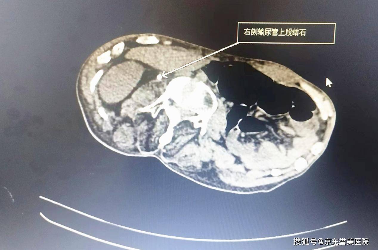 经过ct及血常规检查显示,王先生右侧肾盂输尿管交界处结石,合并肾轻度