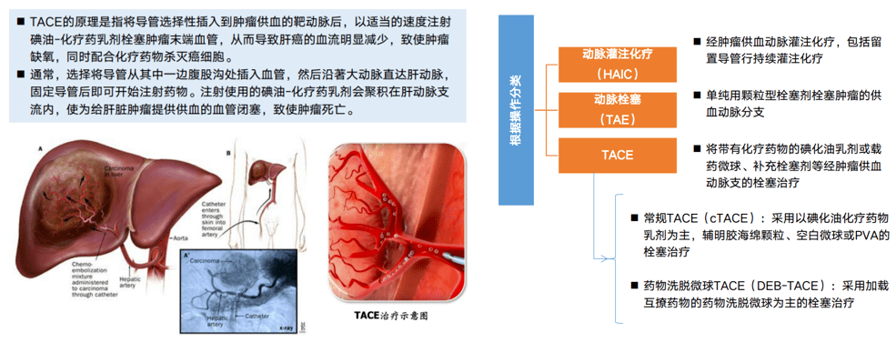 腫瘤動脈同時結合抗腫瘤藥物,使腫瘤組織缺血缺氧併產生細胞毒性作用