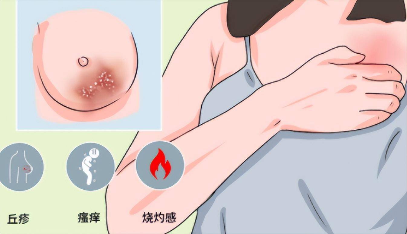 胸部湿疹是由什么原因引起的(乳房湿疹怎么办如何预防)