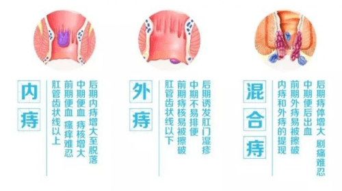 外痔出血 来自搜狐网