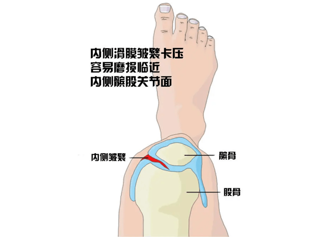 交锁较轻时,可通过患者自己小范围摇晃,扭转膝关节解锁