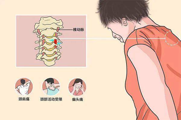 颈椎压迫脊髓早期症状图片