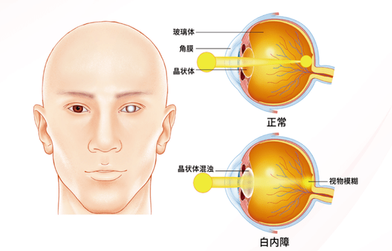 晶狀體_手術_視力