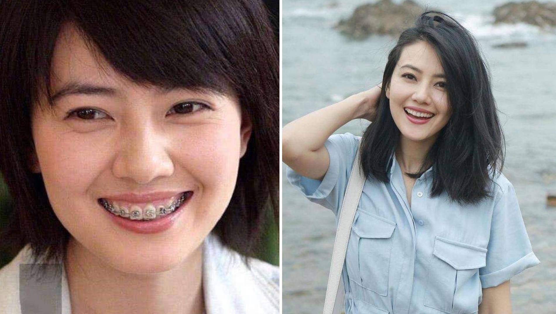 北京大妞高圆圆堪称原装女子,长相可人气质清淡,可也深受龅牙之苦.