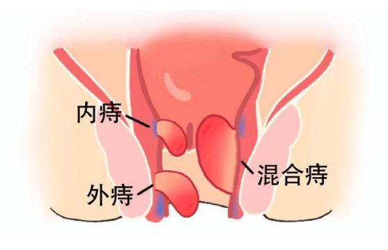 贵阳东大肛肠医院:混合痔—痔疮中的狠角色!惹上了怎么办?