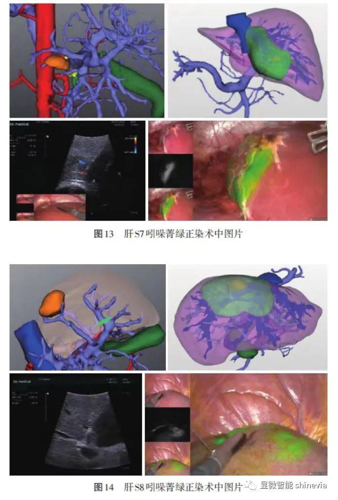 共识解读 | 吲哚菁绿荧光成像技术在肝脏外科的应用_染色_胆管_解剖