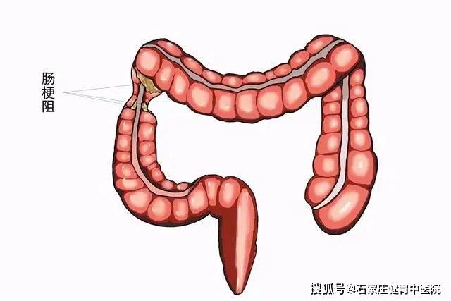 醫生一旦聽到病人主訴大便次數增多,有粘液甚至膿血便,往往不經檢查就