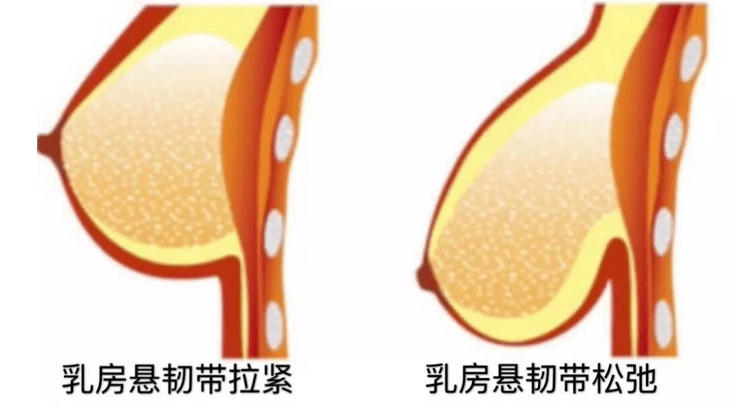 乳房悬韧带断裂图片图片