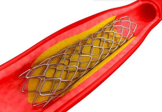 2022年心脏支架图片图片