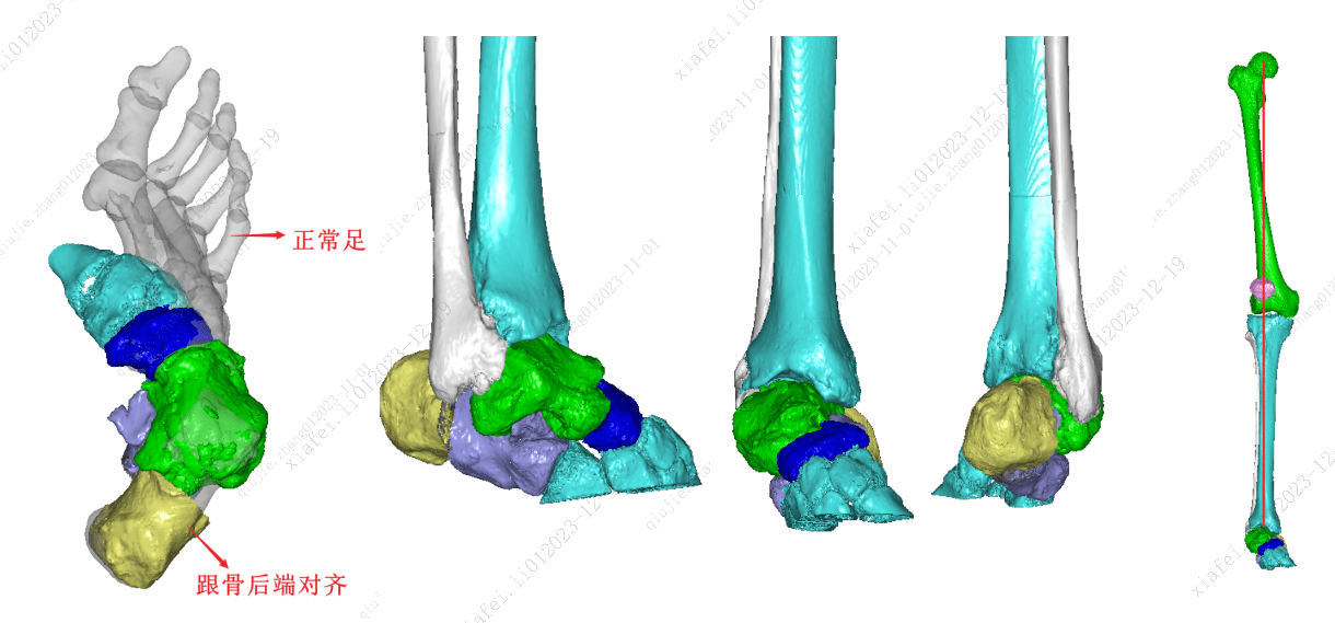 骨科三維重建&手術設計——右跟骨內翻畸形矯形手術三維分析方案_技術