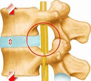 腰椎間盤突出,這些問題,你重視過嗎?_鍛鍊_動作_症狀