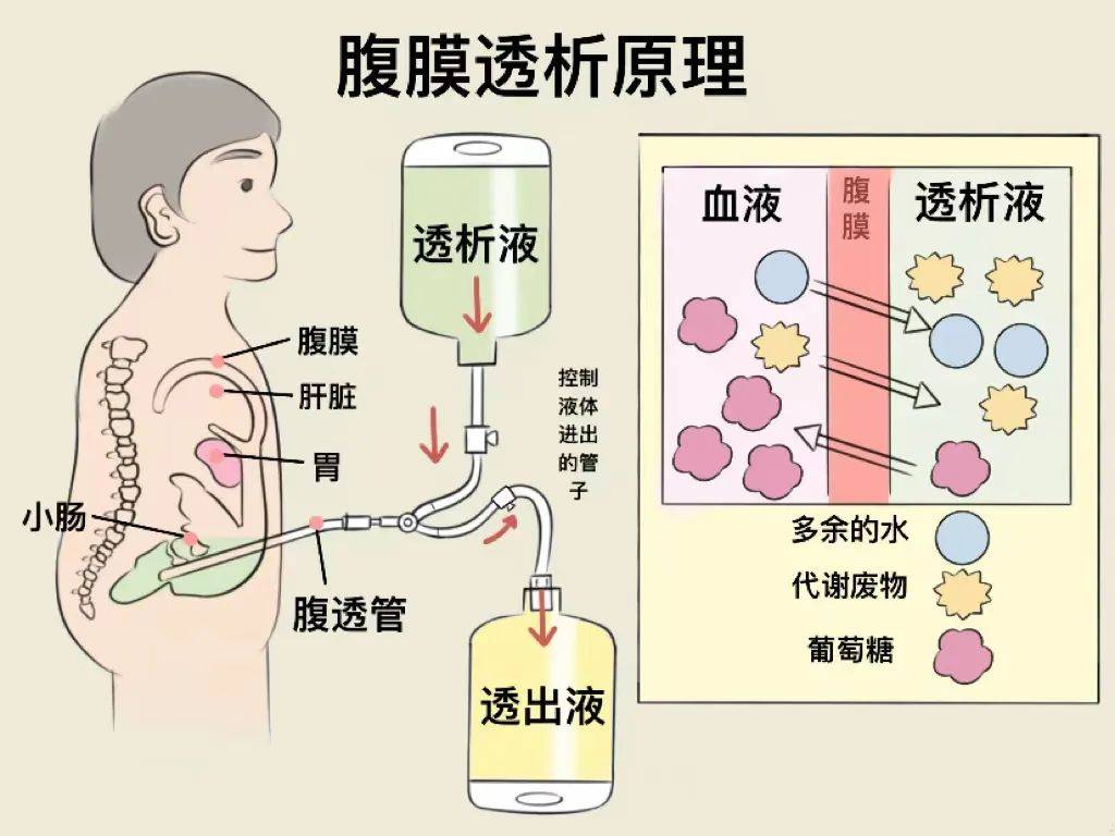 会昌县人民医院肾内内分泌科成功开展腹膜透析技术打通尿毒症患者又一