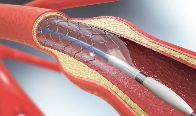 国内或将逐渐停止心脏支架手术?做完人就废了?