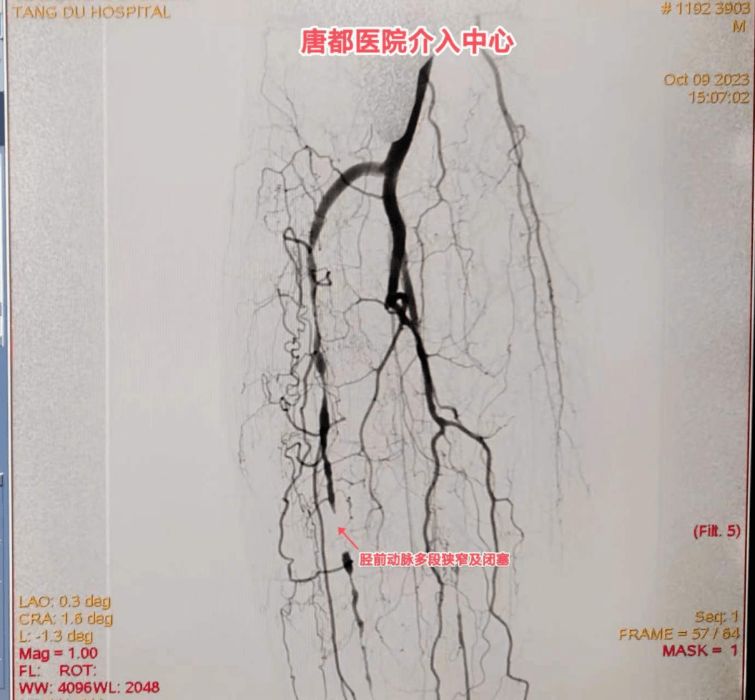 無力,發涼,行走活動後右側尤為明顯,右側膎動脈及足背動脈不可捫及