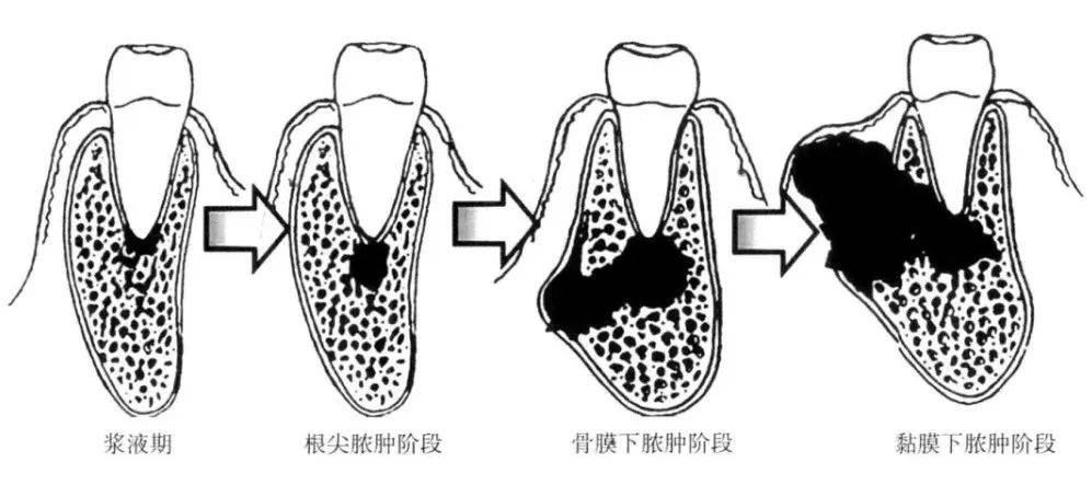 根尖周炎的治疗方法图片