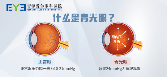 青海愛爾:青光眼是致盲病因,是不可逆致盲眼病_因素_眼壓_疾病