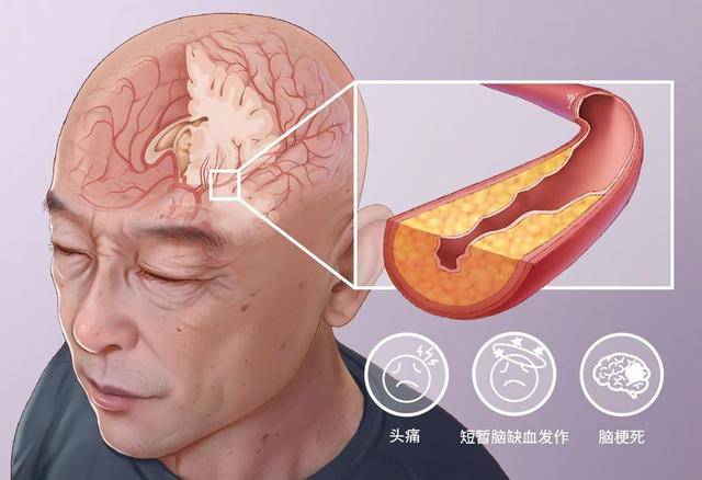 帕金森病患者在情绪调节上存在困难,更容易出现抑郁和焦虑等情绪问题