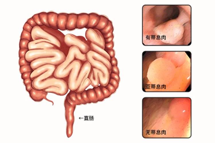 關於肛診,一文告訴你_檢查_進行_肛門