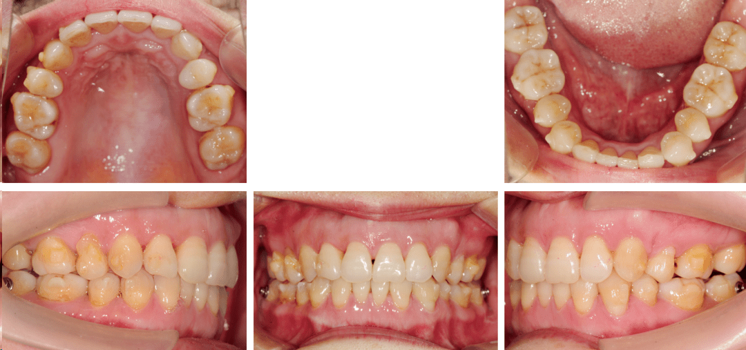 ds正畸|牙周情況不良的骨性Ⅱ類拔牙病例的隱形矯治_治療_下頜_分析