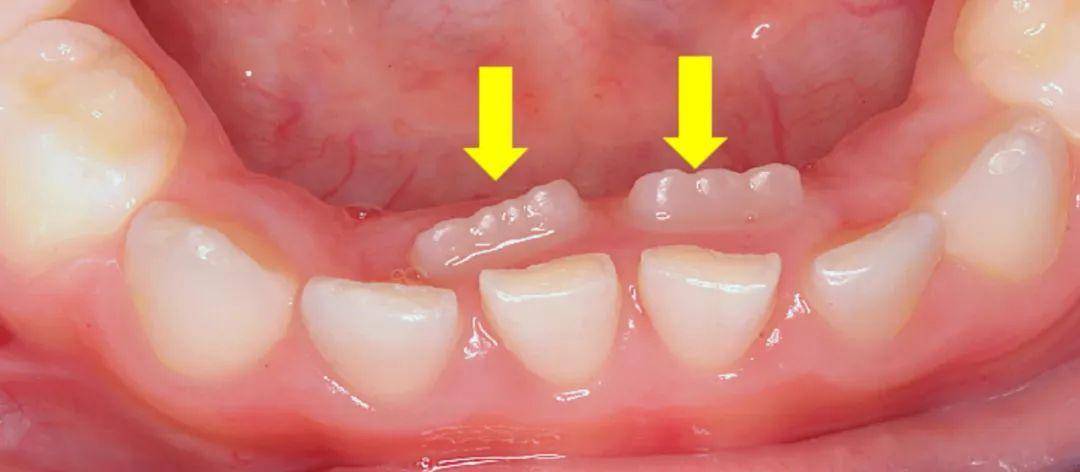 孩子长出双排牙,家长记得这样做