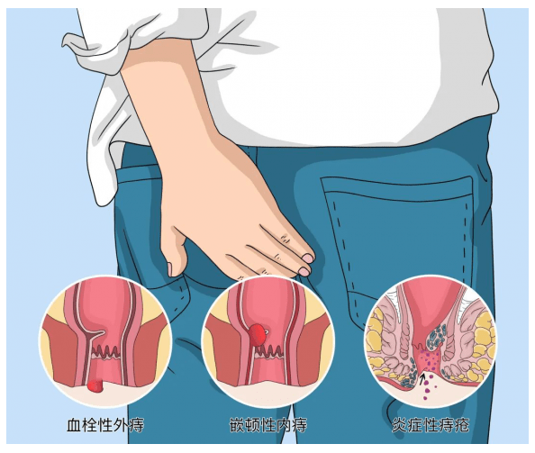 血栓性外痔 早期图片