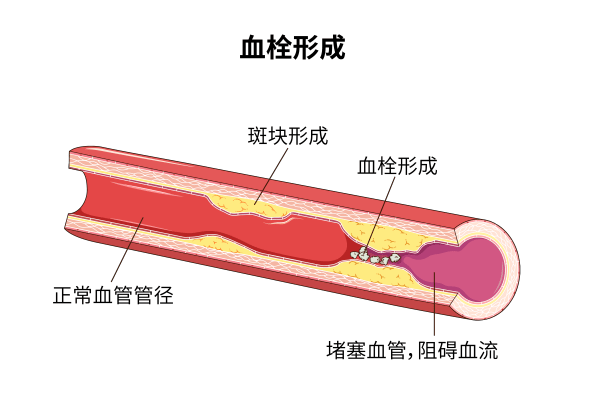 很多人半身不遂後才發現!這套血管鍛鍊操轉給你_動脈_血液_心臟