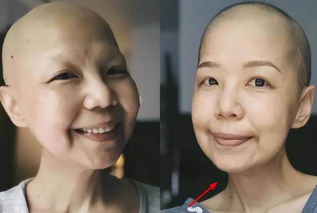 48岁导演陈慧翎宫颈癌去世!一月前还很乐观,生前化疗暴瘦到变形