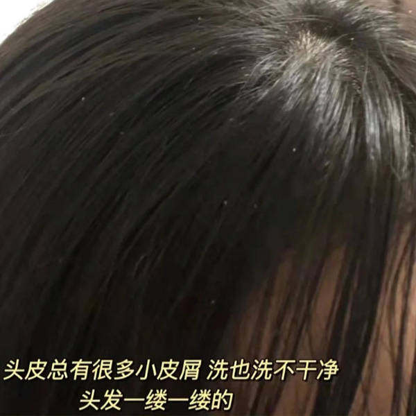 二硫化硒洗头发还需要用洗发水吗?去屑止痒控油的洗发水推荐