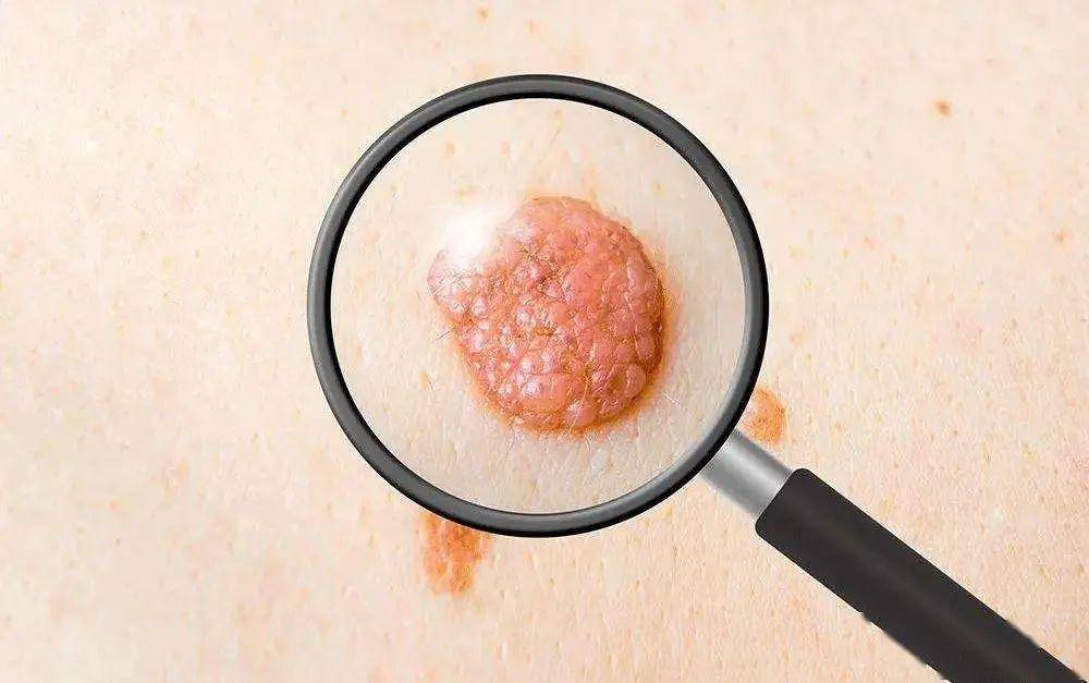 【当心】这2个部位长痣,可能会癌变?