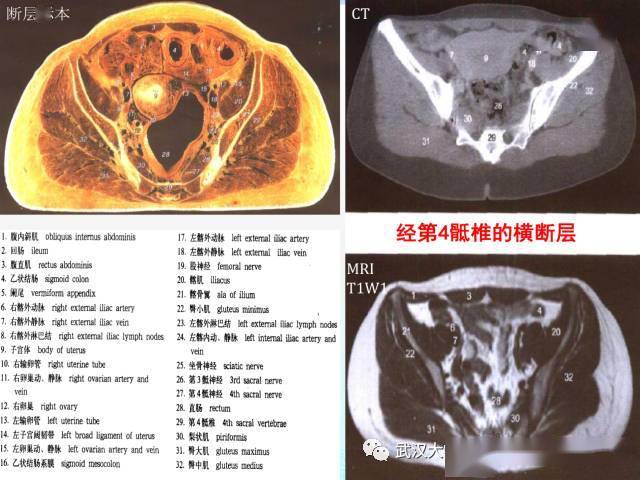 女性盆腔解剖与断层影像