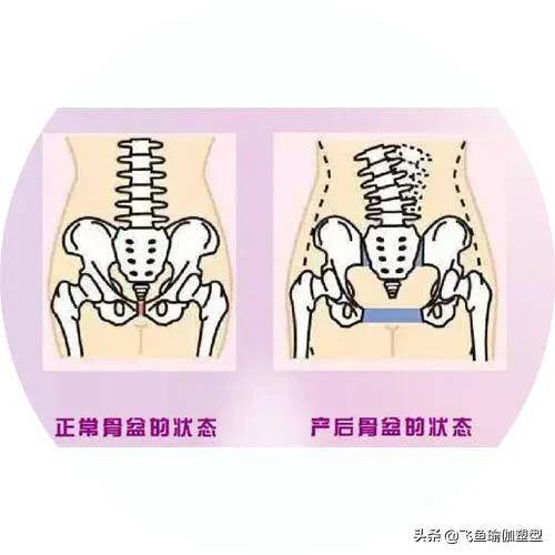 产后腰痛如何有效恢复_骨盆