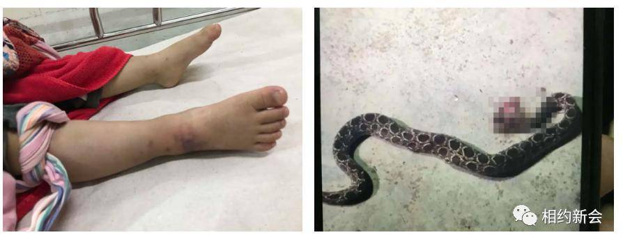 据了解,男孩于当晚在恩平家中玩耍时不慎被蝰蛇咬伤右腿,新会交警与