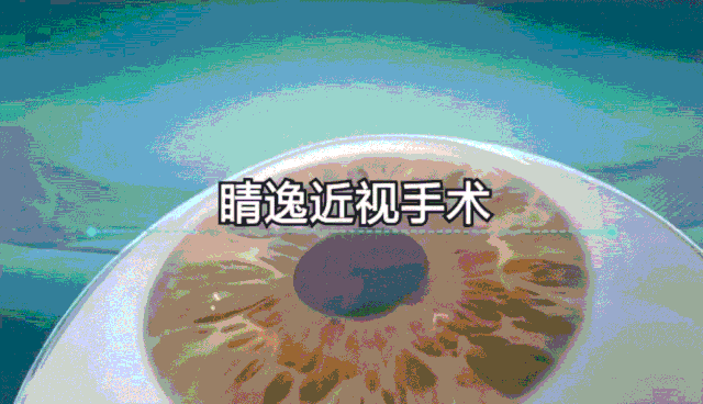 精雕激光 近视手术精雕系列近视手术是指爱尔眼科屈光手术团队根据多